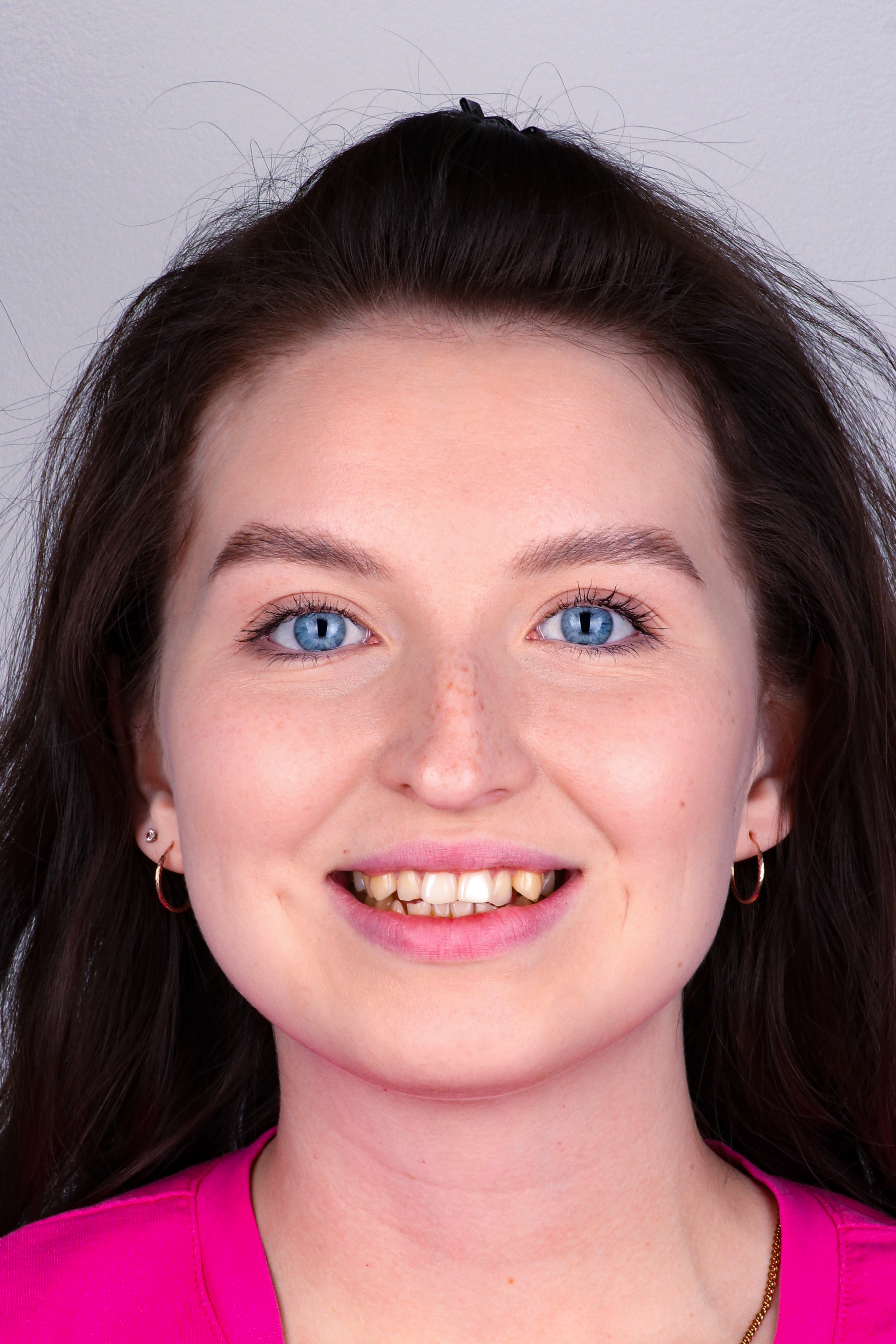 Кейс Тараскиной - до лечения